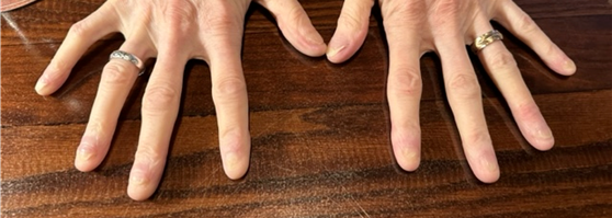 Abused Fingernails 